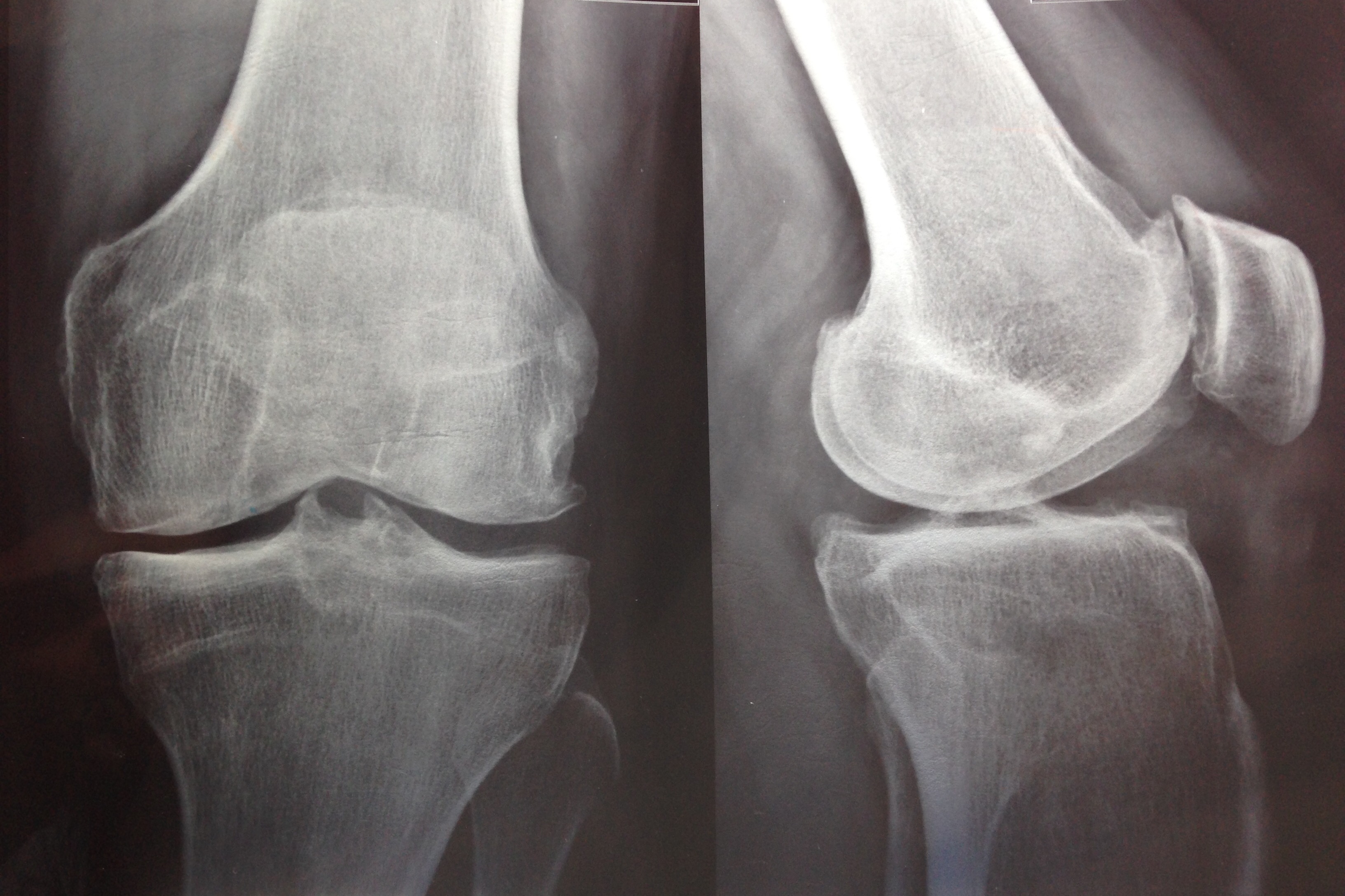 Buscando el mejor tratamiento para la artrosis de rodilla…